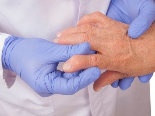 Conoscere a fondo una malattia è fondamentale prima di iniziare un adeguato percorso di cura: scopri cos'è l'artrite reumatoide! Artrite reumatoide mani